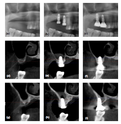 Radiologic comparative analysis between saline and plateletrich fibrin filling after hydraulic transcrestal sinus lifting without adjunctive bone graft: A randomized controlled trial