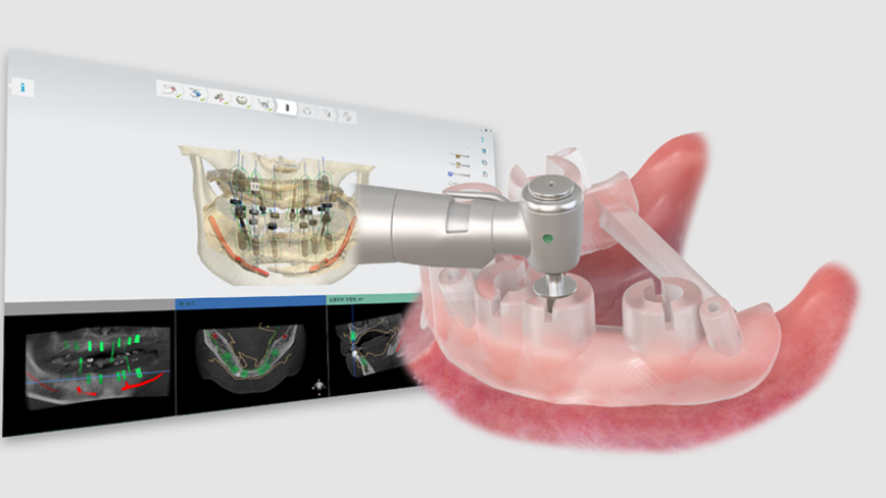 OneGuide de Osstem Implant celebra su 10º aniversario, fortaleciendo su competitividad en la odontología digital